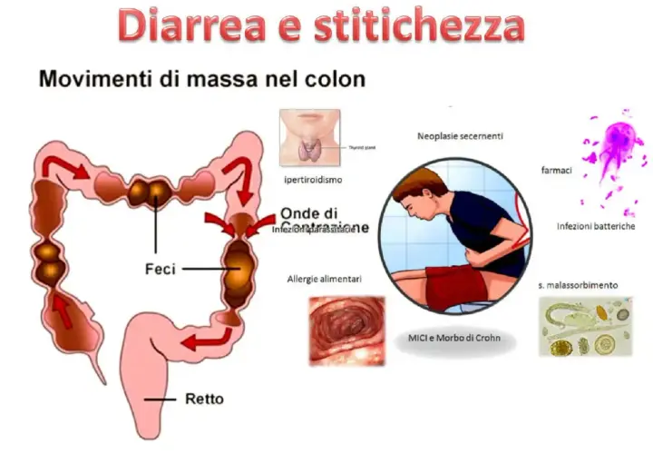 Diarrea e stitichezza: cause e rimedi. Immagine mostra colon, feci, retto, ipertiroidismo, infezioni, allergie, farmaci, malassorbimento.