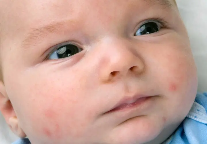 Primo piano del viso di un neonato con lievi arrossamenti e qualche piccolo brufolo, tipici dell'acne neonatale.
