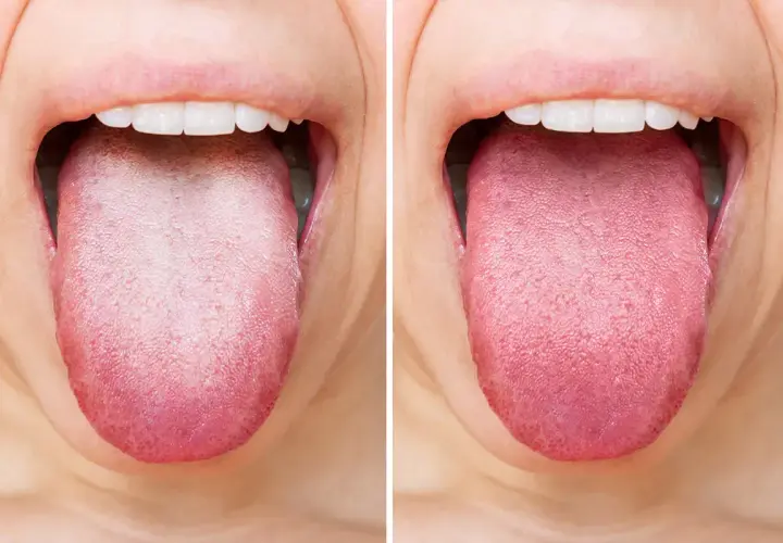 Comparación de lenguas: una muestra la suciedad en la lengua, la otra muestra una lengua limpia y rosada.