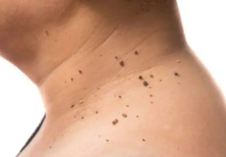 Primer plano de la piel del cuello mostrando varios tipos de manchas, incluyendo lunares y verrugas.