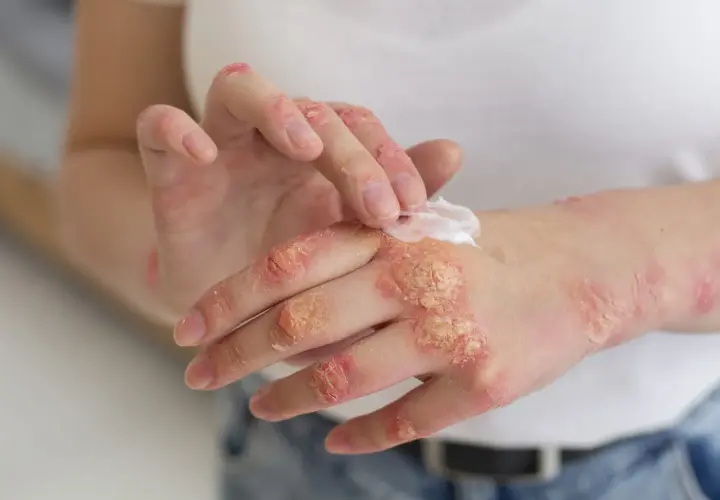 Manos con psoriasis, aplicando crema para aliviar la piel seca y escamosa.