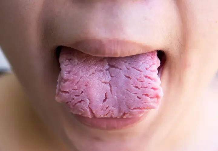 Primer plano de una lengua roja con surcos profundos, asomando entre los labios.