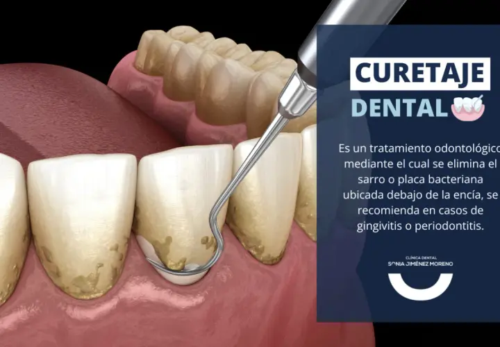 Instrumento dental elimina sarro bajo la encía, esencial para la limpieza periodontal y prevenir la periodontitis.