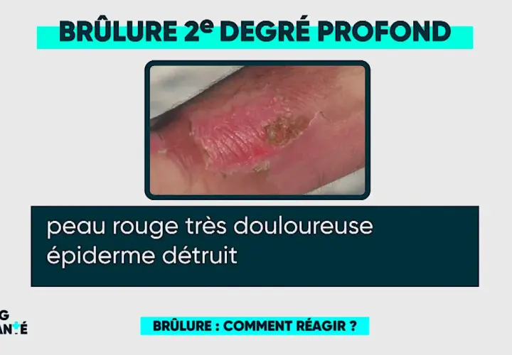 Brûlure 2e degré profond sur la main, peau rouge et douloureuse, épiderme détruit. Une brûlure eau bouillante degré.