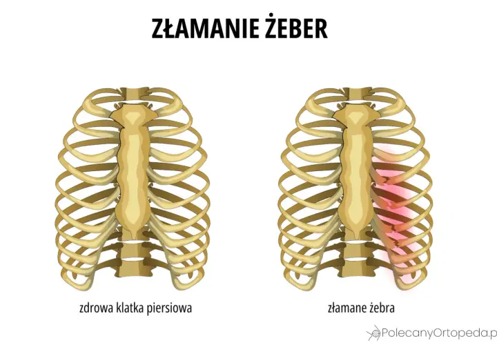 Porównanie zdrowej klatki piersiowej z klatką z widocznym złamanym żebrem, zaznaczonym na czerwono.
