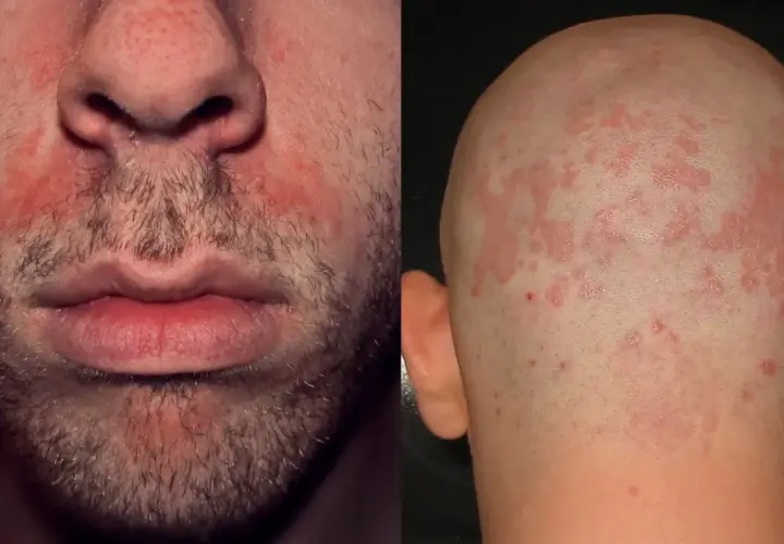 Viso e cuoio capelluto con arrossamenti e squame, segni tipici della dermatite seborroica.