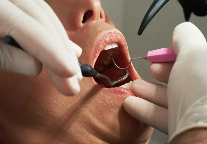 Zabieg ekstrakcji zęba przy stanie zapalnym. Dentysta w rękawiczkach używa narzędzi do usunięcia zęba.