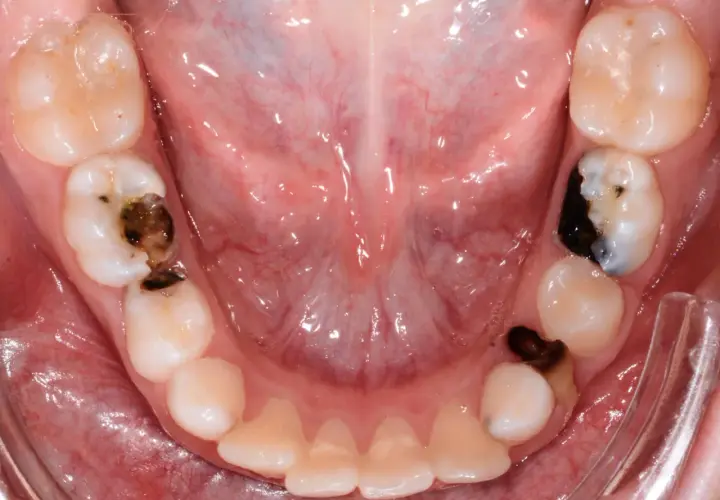 Denti da latte con carie evidenti, alcuni con otturazioni scure.