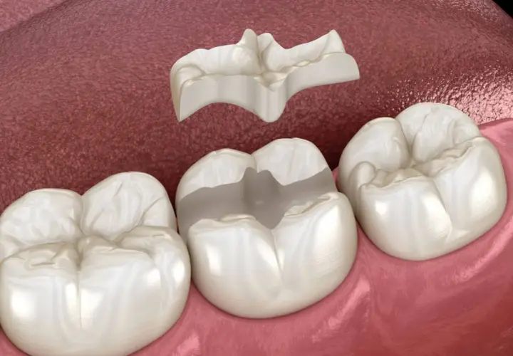 Una incrustación cerámica dental lista para ser colocada en un molar.