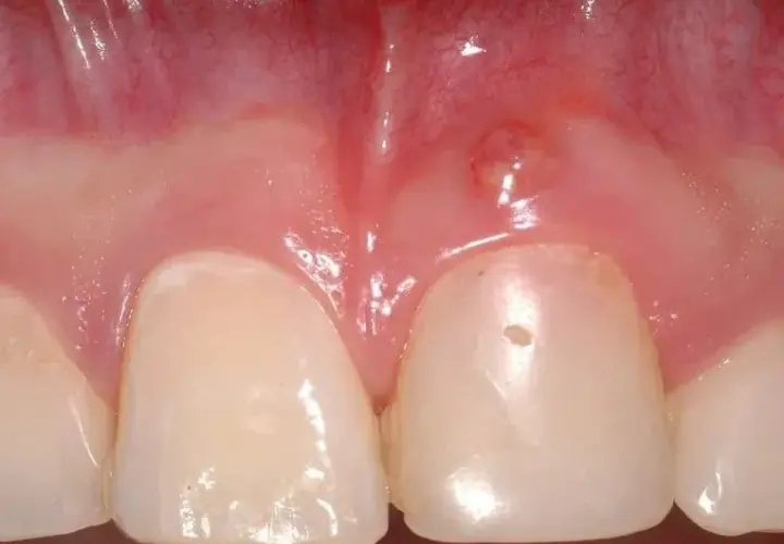 Zapalenie dziąseł u dziecka: Szybka ulga i kiedy do dentysty?