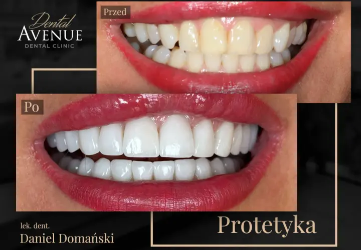 Przed i po: metamorfoza uśmiechu dzięki licówkom. Sprawdź, jaka jest licówki cena i odmień swój wygląd!