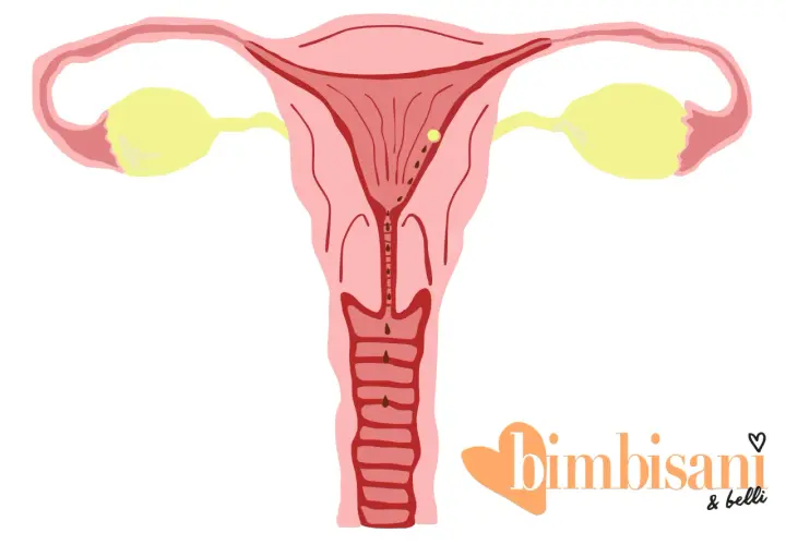 Utero con ovidotti e ovaie. Piccole macchie marroni indicano possibili perdite da impianto.