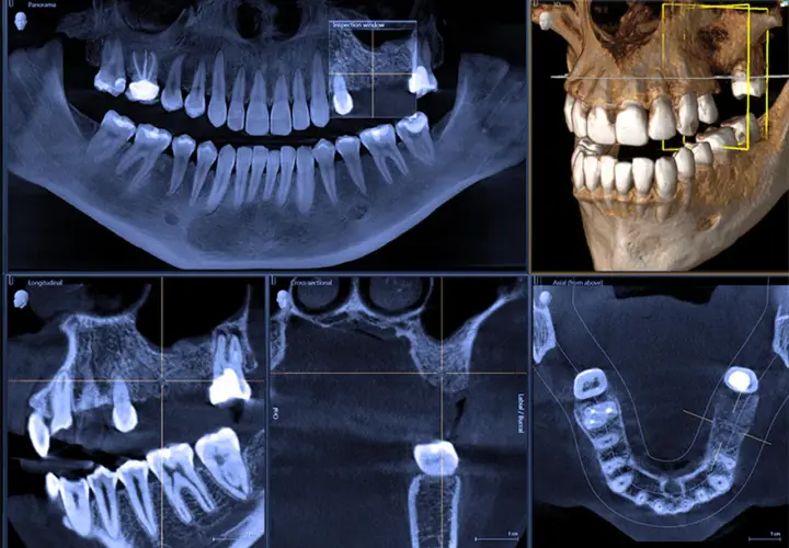 Tomografia CBCT prezentuje obraz zębów i szczęki w przekrojach: panoramicznym, osiowym, strzałkowym i poprzecznym.
