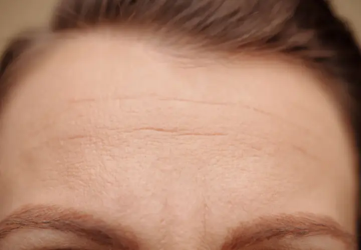 Close-up of a forehead with visible horizontal wrinkles and eyebrows.