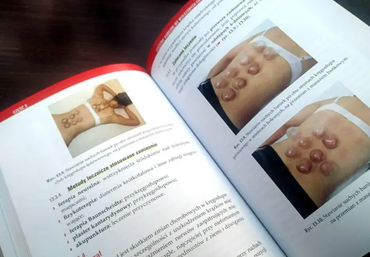 Książka omawia techniki stawiania baniek na plecach, ilustrując je na przykładach.