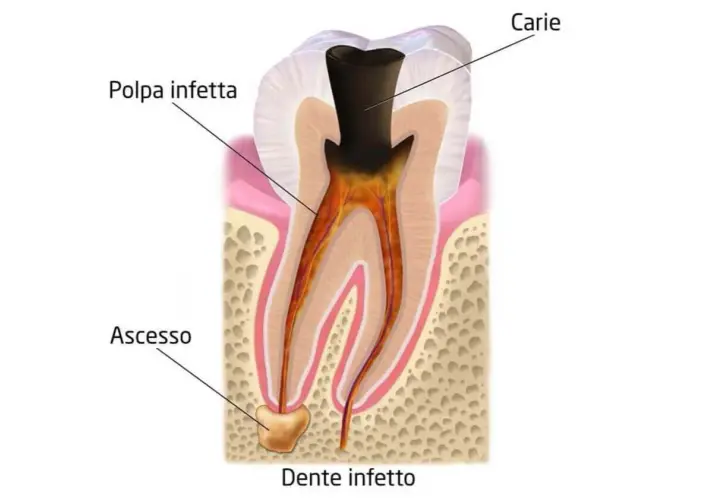 Sezione di un dente con carie e polpa infetta. Alla base della radice si nota un ascesso, segno di un dente infetto.