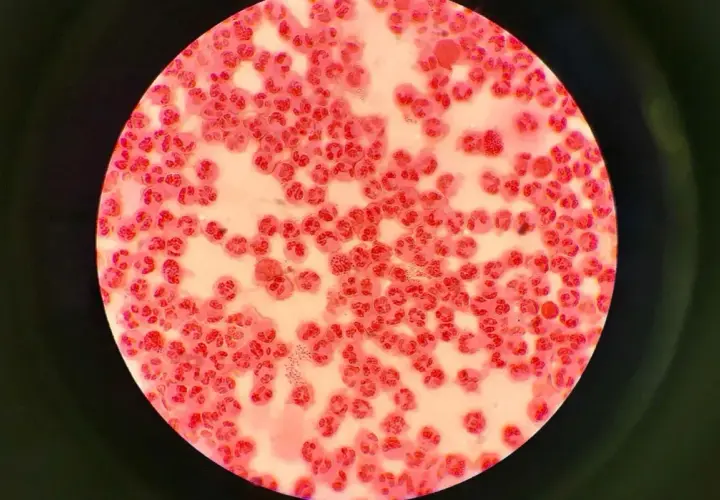 Mikroskopowy obraz komórek zapalnych i bakterii Neisseria gonorrhoeae, które mogą powodować rzeżączkę na penisie.