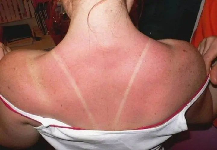 Dos lignes claires sur un dos rouge vif, témoignant d'un coup de soleil. Voici comment faire dérougir un coup de soleil.