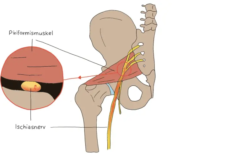 Illustration zeigt, wie der Ischiasnerv durch den Piriformis-Muskel komprimiert wird, was zu Schmerzen führt.