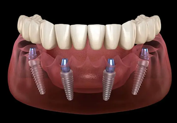 Immagine 3D di un'arcata dentale superiore con protesi fissa su quattro impianti, dimostrando la tecnica di implantologia all on four.
