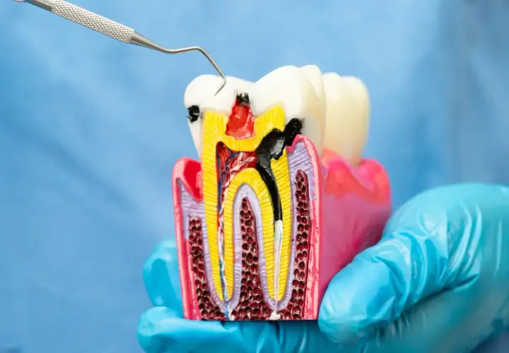 Model zęba z widocznym ubytkiem i narzędziem dentystycznym. Zastanawiasz się nad leczeniem kanałowym? Cena może być niższa niż myślisz.