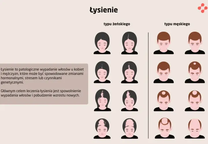 Ilustracja pokazuje różne etapy łysienia u kobiet i mężczyzn, w tym łysienie z tyłu głowy.