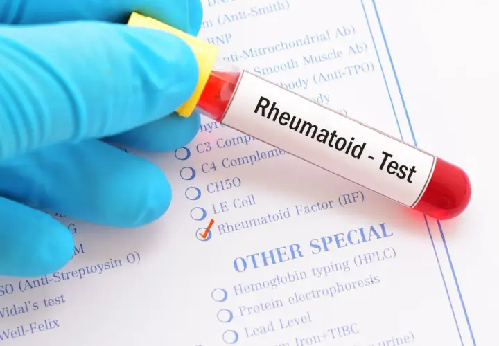 Rękawiczka w niebieskiej rękawiczce trzyma probówkę z napisem "Rheumatoid - Test". Zaznaczono "Rheumatoid Factor (RF)", co sugeruje, że to badanie na obecność czynnika reumatoidalnego.