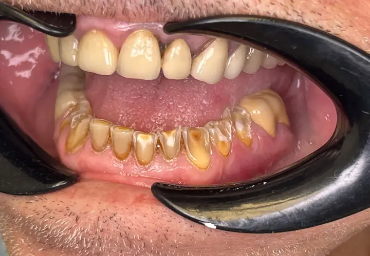 Boca abierta con dientes amarillentos y desgastados, mostrando signos de **abrasión dental**. Se aprecian restauraciones y encías inflamadas.