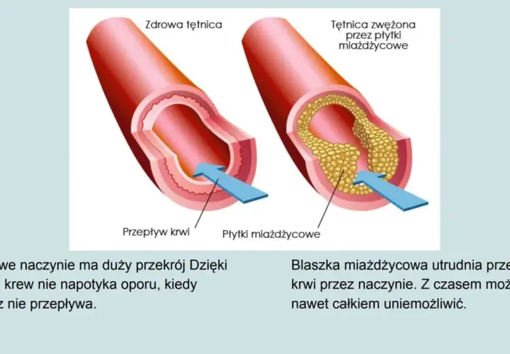 Porównanie zdrowej tętnicy z tą zwężoną przez płytki miażdżycowe. Układ krwionośny jest kluczowy dla zdrowia.