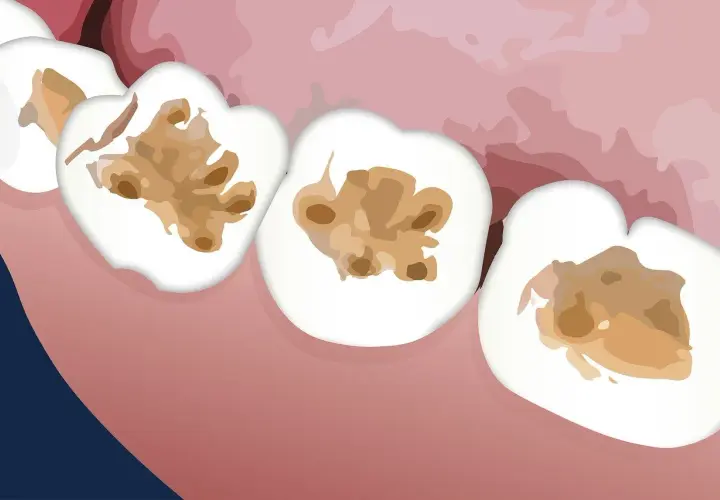Dientes con cavidades marrones y oscuras, indicando caries en dentina.