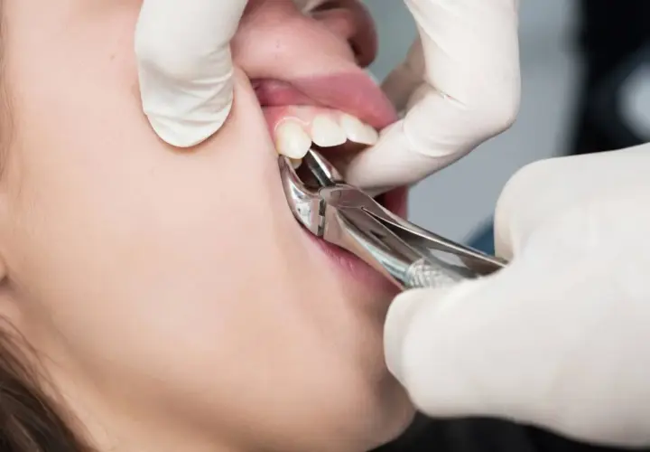 Dentysta usuwa ząb kleszczami. Zastanawiasz się, ile kosztuje wyrwanie zęba prywatnie?