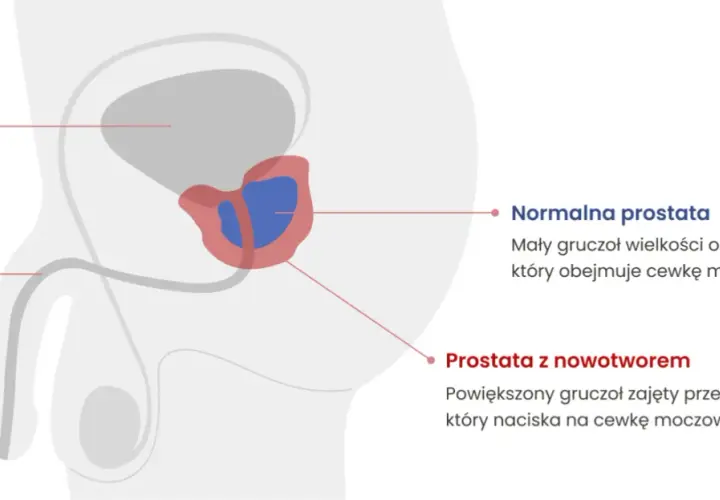 Choroba prostaty objawy - jak je rozpoznać i uniknąć powikłań