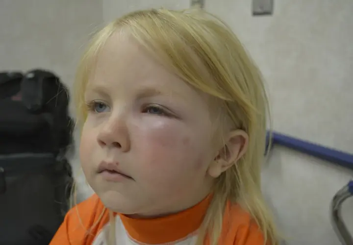 Silne uczulenie na komary u dziecka. Powieka jest mocno opuchnięta, zaczerwieniona, z widocznymi śladami ukąszeń na policzku.