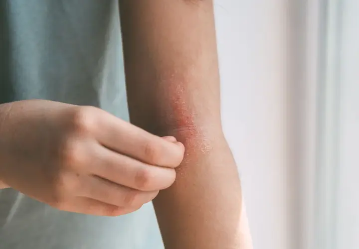 Skóra na łokciu swędzi i jest zaczerwieniona. Czas na wizytę u dermatologa, by znaleźć przyczynę i ulgę.