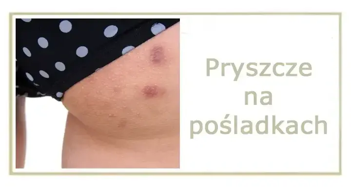 Pryszcze na pośladkach? Poznaj skuteczne metody i gładką skórę!