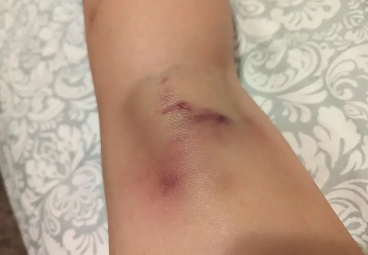 Widoczne siniaki na nodze, pamiątka po intensywnym treningu pole dance.