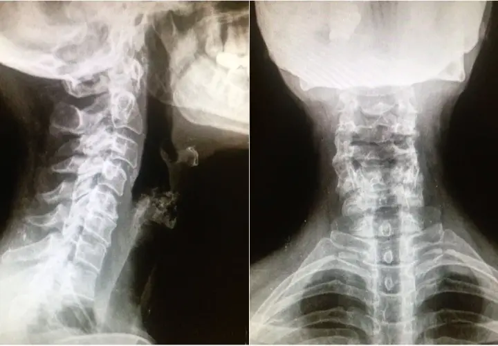 Síntomas de artrosis cervical grave: identifica el dolor y la debilidad