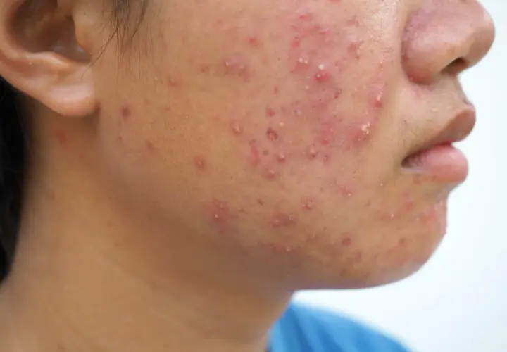Primer plano de la mejilla de una persona con numerosos granos rojos e inflamados, algunos con pus, indicativos de acné fungico.