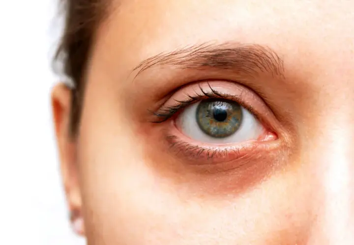 Œil humain avec des cernes visibles sous l'œil, suggérant des solutions pour comment atténuer les cernes.