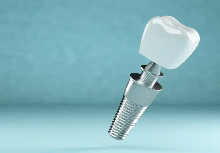 Odrzucenie implantu zęba po jakim czasie? Poznaj kluczowe czynniki
