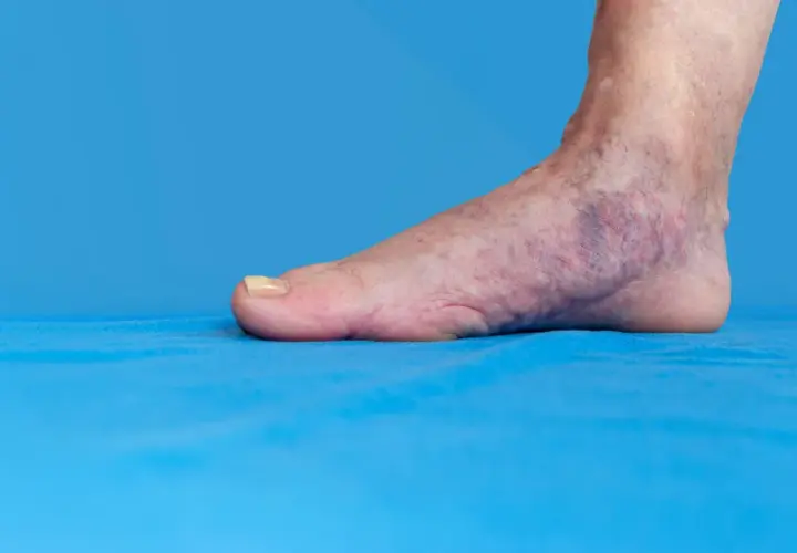 Fuß mit blauen Verfärbungen und sichtbaren Venen auf blauem Hintergrund.