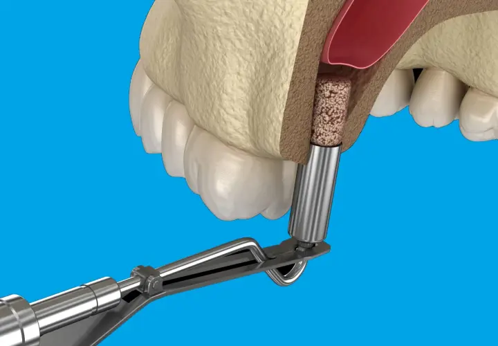 Chirurgiczne narzędzie wprowadza materiał kostny do wyrostka zębodołowego, przygotowując go do implantacji.
