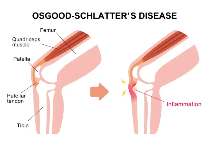Ilustracja pokazuje rozwój choroby Osgood-Schlatter. Po lewej zdrowa anatomia kolana, po prawej zapalenie więzadła rzepki.