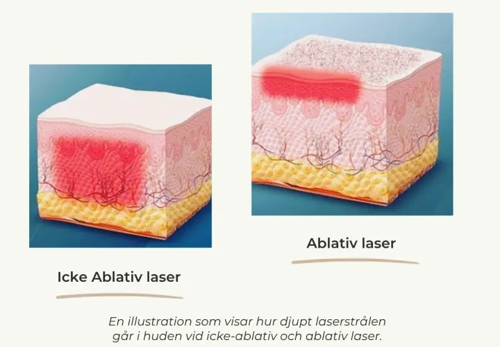 Illustrationer visar hur en co2 laser påverkar huden. Icke-ablativ laser värmer djupare, ablativ laser avlägsnar ytskiktet.