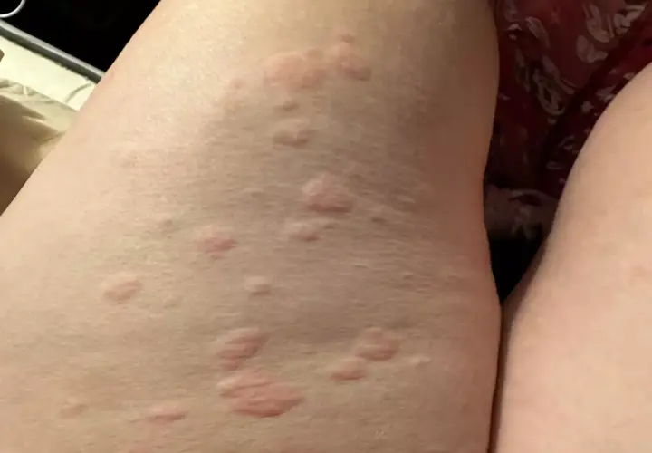 Eruzione cutanea con pomfi rossi e pruriginosi sulla pelle, possibile orticaria parainfettiva.