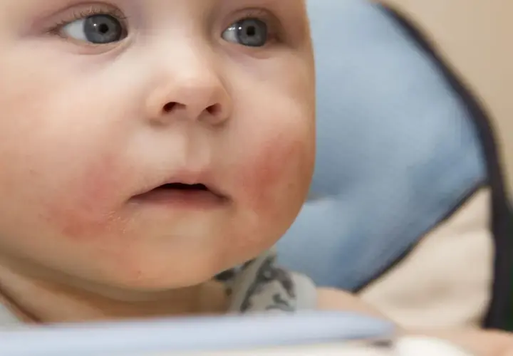 Czerwone, suche policzki dziecka mogą wskazywać na uczulenie na gluten.