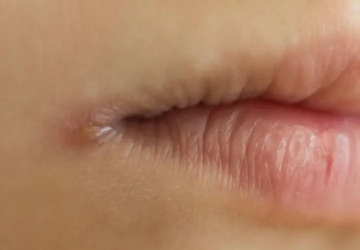 Nahaufnahme eines Mundes mit einem kleinen Pickel am Mundwinkel. Dies könnte ein Hinweis auf eine Mundrose sein, für die eine Therapie notwendig ist.