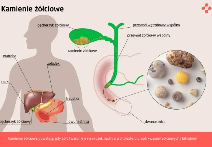 Ilustracja przedstawia anatomię człowieka z zaznaczonym pęcherzykiem żółciowym, gdzie widoczne są kamienie żółciowe. Pokazuje też drogi żółciowe i narządy trawienne.