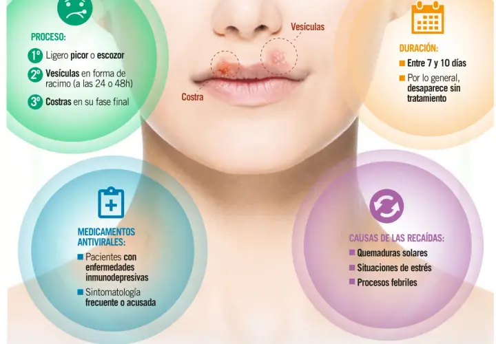 Herpes labial por estrés: el proceso incluye picor, vesículas y costras. Las recaídas pueden ser por estrés.
