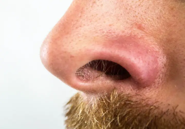Primer plano de una nariz con poros visibles y algunas espinillas negras. Se aprecia vello facial en la parte inferior.